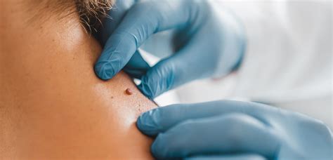 skin tags removal procedure